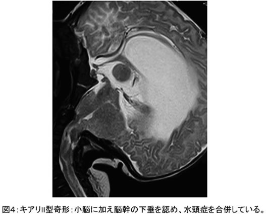 図4:キアリII型:小脳に加え脳幹の下垂を認め、水頭症を合併している。