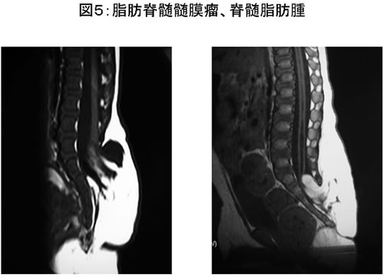 図5:脂肪席髄膜瘤、脊髄脂肪腫