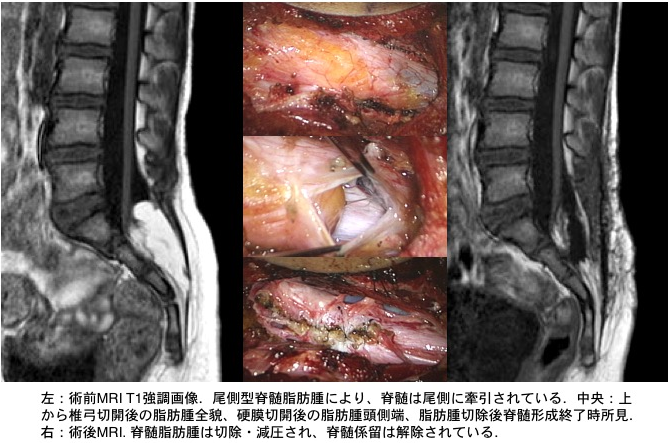 図4:脊髄円錐部脂肪腫（尾側型）手術