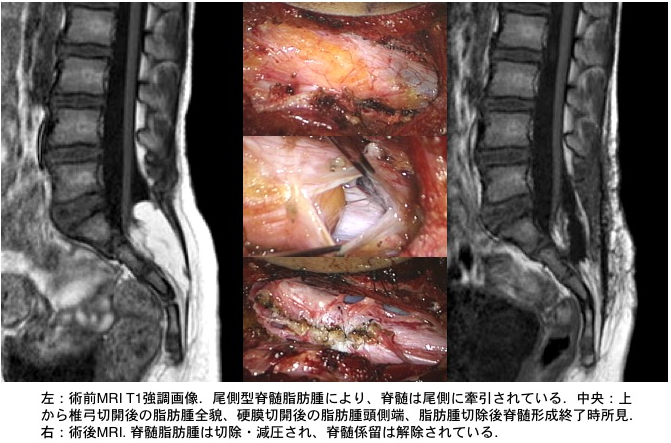 図4:脊髄円錐部脂肪腫(尾側型)手術