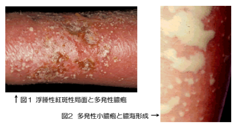 図1.浮腫性紅斑性局面と多発性膿疱　図2.多発性小膿疱と膿海形成
