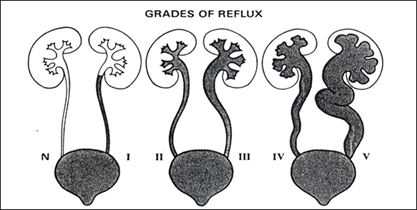GRADES OF REFLUX